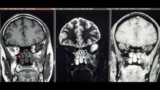 MRI in MucorMycosis  Necrosed Sphenopalatine amp Maxillary Artery  Necrosed Pterygopalatine Fossa [upl. by Tooley977]