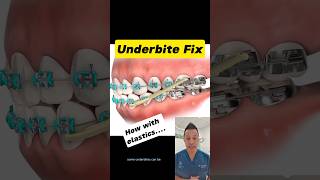 Elastics to Fix Your Underbite Heres How dentallan dentist shorts [upl. by Clere989]