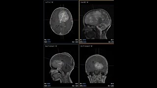 Huge supratentorial brain lesion in a 9 year old boy [upl. by Arihsan]