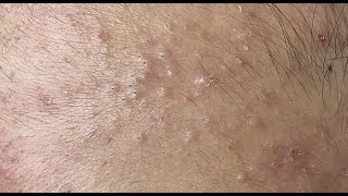 Squeezing blackheads on the forehead HoangMySpa70 [upl. by Siegler]