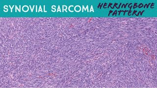 Synovial sarcoma monophasic with classic quotherringbonequot pattern soft tissue pathology [upl. by Kirwin808]