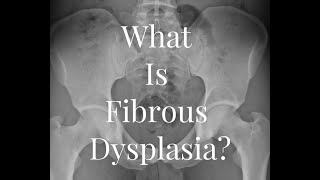 Fibrous Dysplasia Monostotic or Polyostotic  Defibition causes characteristics Symptoms [upl. by Eveneg]