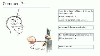 Intérêt de la DVE dans la gestion de lHTIC  Dr Marie Werner [upl. by Stafani824]