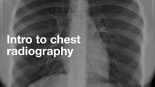 Introduction to Chest Radiography [upl. by Ahseikram]