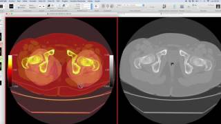 ANTEVERSION FEMORAL [upl. by Davita]