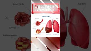 Lung sound in Pneumonia [upl. by Leehar]