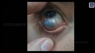 Guess the condition eyecareoptom conjunctiva eye eyeproblem [upl. by Epstein]