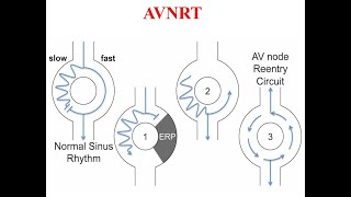 mechanism of  AVNRT [upl. by Hilten]