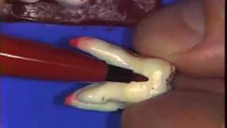 Dental Anatomy Maxillary Molars Review [upl. by Hcardahs519]