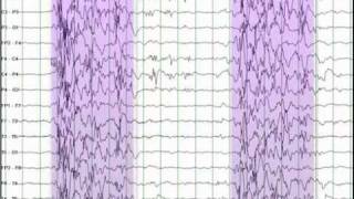 EEG Reading Rounds Burst Suppression [upl. by Ellehcen825]