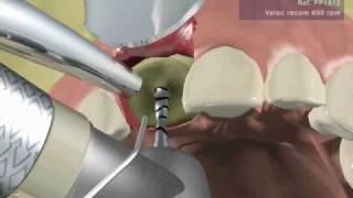 IMPLANTE DENTAL UNITARIO fase quirúrgica [upl. by Anirres]