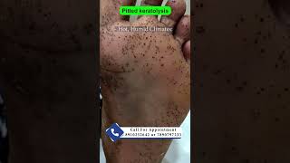 Pitted keratolysis  By Dr Uttam Kumar Lenka MBBS MD Consultant Dermatologist [upl. by Dibbell565]