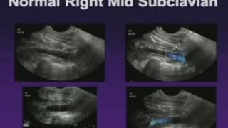 Upper Extremity Venous Exam Technique and Interpretation [upl. by Nyleek]