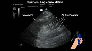 Lung consolidation [upl. by Samella]