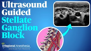 Ultrasound guided stellate ganglion block [upl. by Akira]