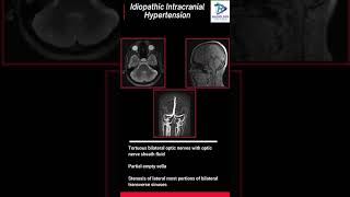 Idiopathic intracranial hypertensionHeadacheMRI Headache protocol [upl. by Florinda]