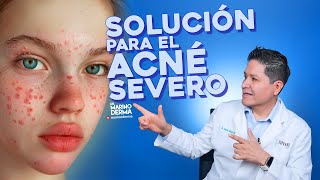 SOLUCIÓN PARA EL ACNÉ SEVERO  Consejos de un dermatólogo [upl. by Dulce]