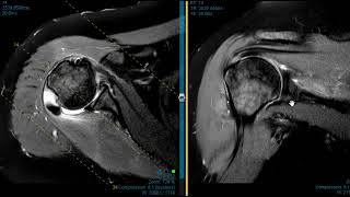 Shoulder pain weakness and instability [upl. by Ranna]