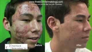 Teen’s Life Changing Laser Treatment For Nodulocystic Acne [upl. by Idnahr268]