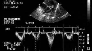 Pulmonary Stenosis [upl. by Ashling]