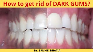 How to get rid of DARK GUMS Dr Srishti Bhatia [upl. by Noraf711]