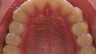 invisalign severe overjet [upl. by Kolivas]