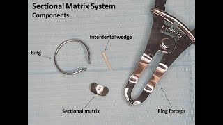 Placement of Sectional Matrix System [upl. by Ryan677]