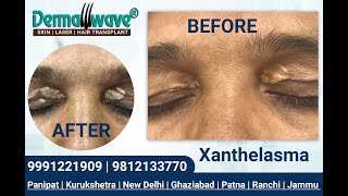 Xanthelasma Treatment  Dermawave Skin Clinic Panipat  Patna  Jammu  Kurukshetra  New Delhi [upl. by Noval]