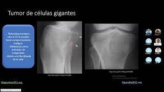 Tumores Oseos Malignos en Rx [upl. by Messing]