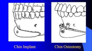 Large Chin Augmentation with Dr Barry Eppley [upl. by Gylys]