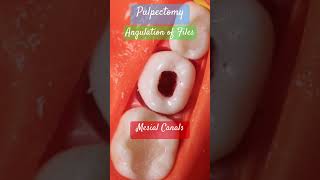 Angulation of files 🟣 Mesial amp Distal Canals 🟤 PULPECTOMY [upl. by Mcnair]