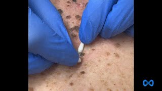 Large Blackheads on the Back [upl. by Elizabeth301]