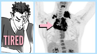 LYMPHOMA After Ignoring 6 WARNING Signs [upl. by Guinn]