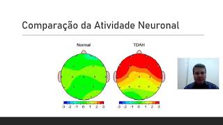 EletroEncefaloGrafia EEG de Superfície para reorientação do TDAH [upl. by Htebaile999]