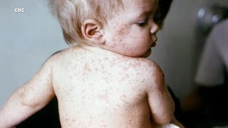 Your child has a viral rash but which one is it Here’s a comparison [upl. by Ariahay]