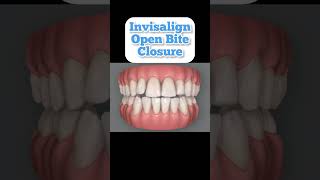 Can Invisalign fix open bite 2023 [upl. by Enirok]