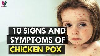 10 Signs and Symptoms of Chicken Pox  health Sutra [upl. by Mun140]