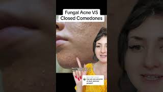 Fungal Acne VS Closed Comedones shorts acne [upl. by Sapphira24]