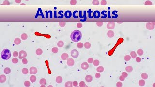 anisocytosis ।। microcytic normocytic and macrocytic cells of rbc [upl. by Esorbma]