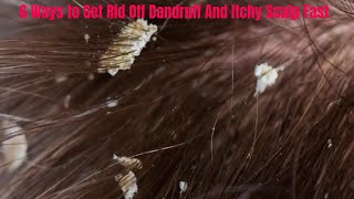 6 Home Remedies for Dandruff and Itchy Scalp for Men and Women [upl. by Frankel675]