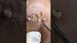 Blackheads Removal Acne Treatment and Very Satisfying Satisfying Pimple pop blackheads [upl. by Aneerhs]