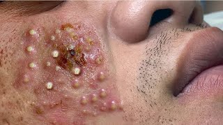 Big Cystic Acne Blackheads Extraction Blackheads amp Milia Whiteheads Removal Pimple Popping  3757 [upl. by Zuzana]