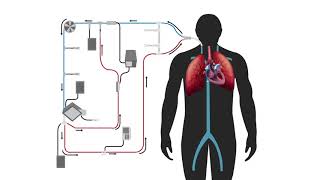 Modified Thermodilution in Extracorporeal Therapy [upl. by Keithley]