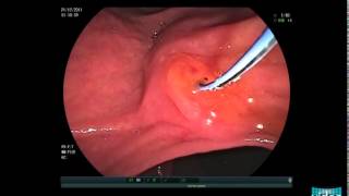 Choledocholithiasis  Sphincterotomy and Stone Extraction with a Basket [upl. by Kylen219]