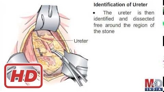 Open ureterolithotomy [upl. by Adrienne]