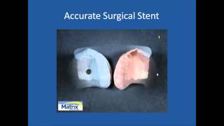 Immediate Denture Surgical Stent Fabrication [upl. by Glick4]