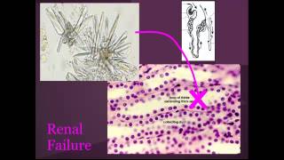 Tumor Lysis syndrome quotEM in 5quot [upl. by Adlihtam620]