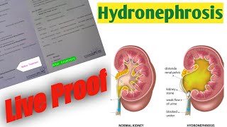 Hydronephrosis Homeopathic Treatment Draravind Homeopathy [upl. by Nicol]