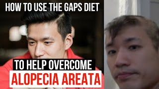 How to use the GAPS diet for alopecia areata [upl. by Nodearb995]