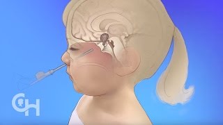 Endoscopic Neurosurgery for Brain Tumors in Children [upl. by Ronnoc]